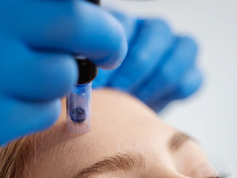 Face & Forehead Microneedling